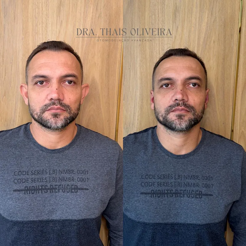 Otomodelação antes e depois — orelha de abano corrigida sem cirurgia em Contagem