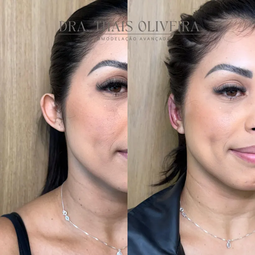 Otomodelação de perfil antes e depois no Eldorado, Contagem