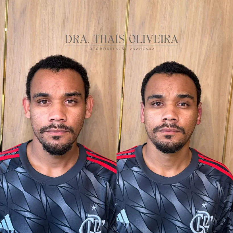 Otomodelação avançada antes e depois — Dra. Thaís, Contagem