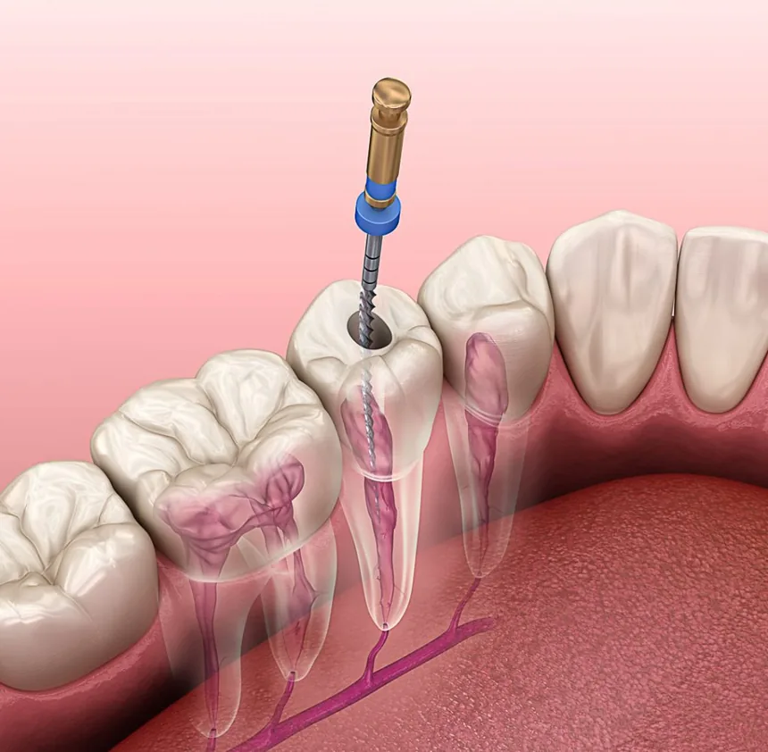 Tratamento de canal (endodontia) em Contagem — OdontoFull