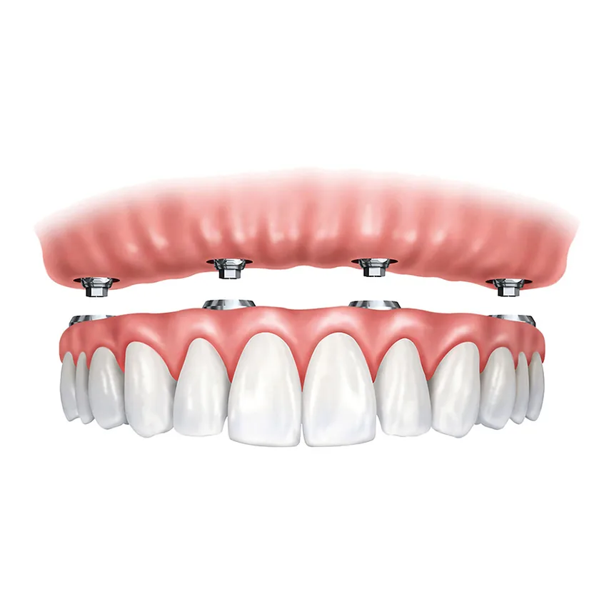 Prótese protocolo fixa sobre implantes em Contagem — OdontoFull