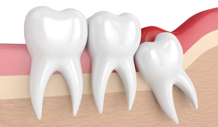 Extração de dente do siso em Contagem — OdontoFull